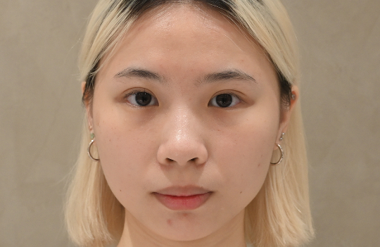 SEYO水光儀+蜂巢皮秒 Before